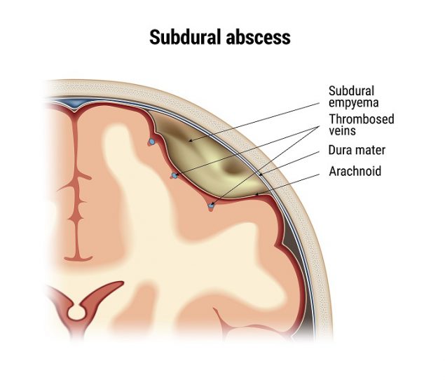 Subdural empyema