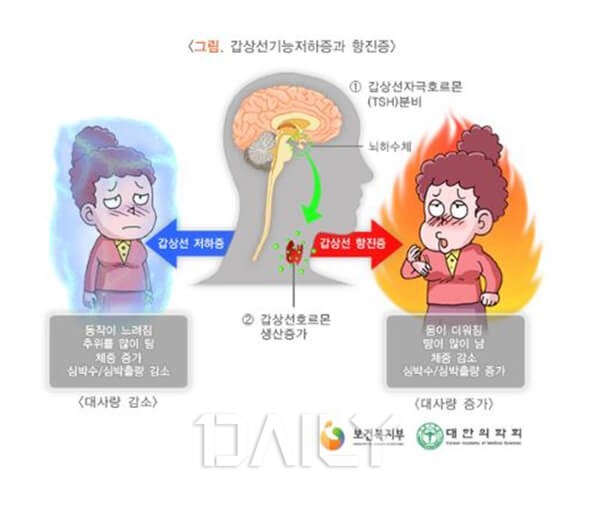 갑상선 기능 항진증
