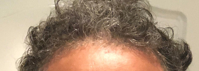 frontal