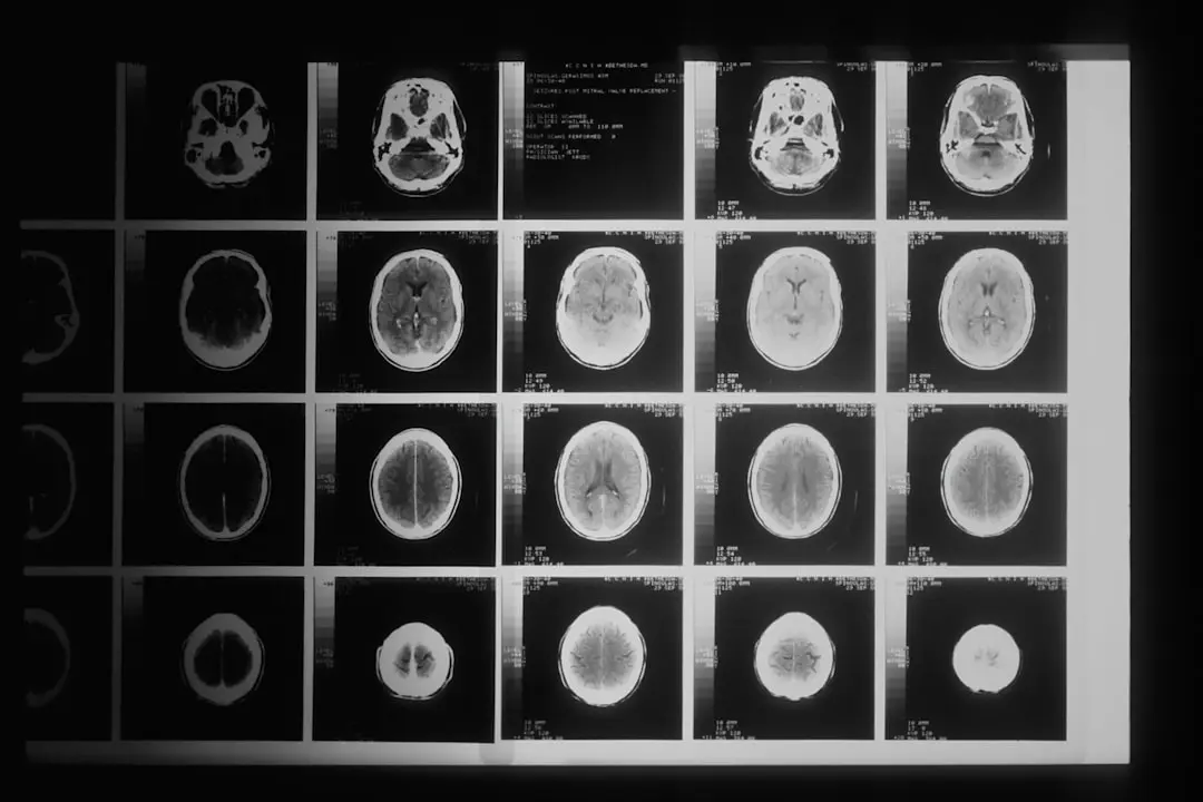 Radioterapia tumorilor cerebrale devine mai predictivă