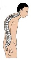 Kyphosis correction surgery