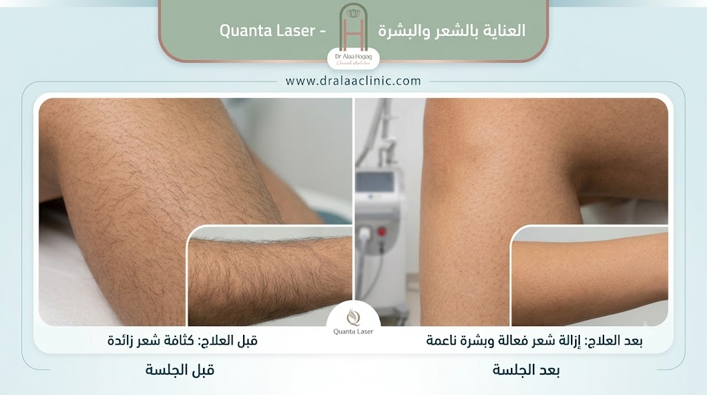 عدد جلسات الكوانتا ليزر حسب المنطقة
