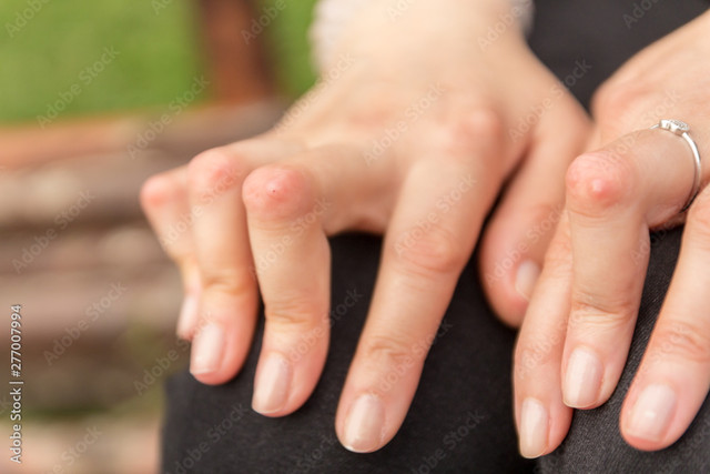 Rheuma-Finger.jpg