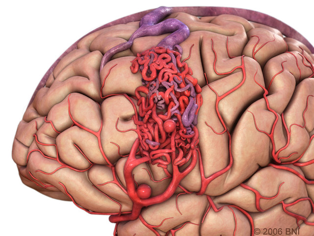 AVM cerebral arteriovenous malformation angiography