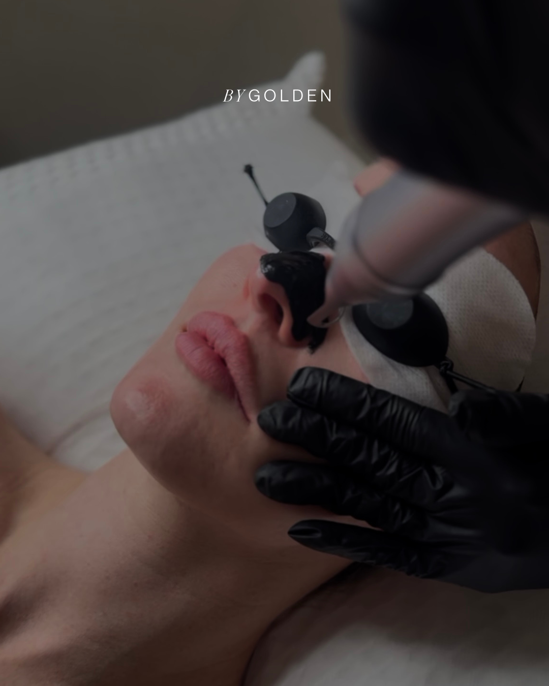 Microneedling + Laser Genesis skin treatment at BYGOLDEN Parkdale