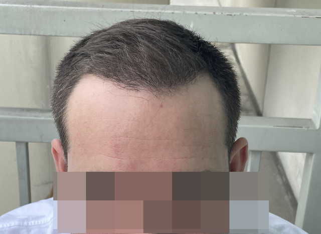FRONTAL-2-PIXEL