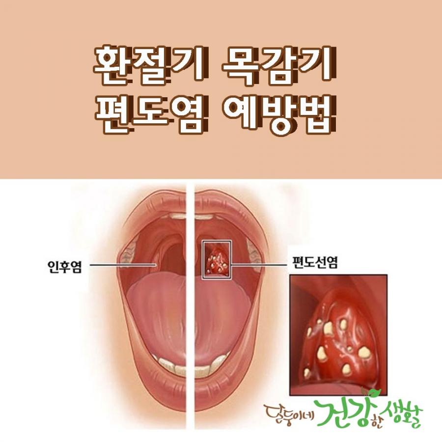 목 감기