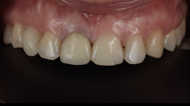 Implantologia przed leczeniem — Smile by Smile Wrocław