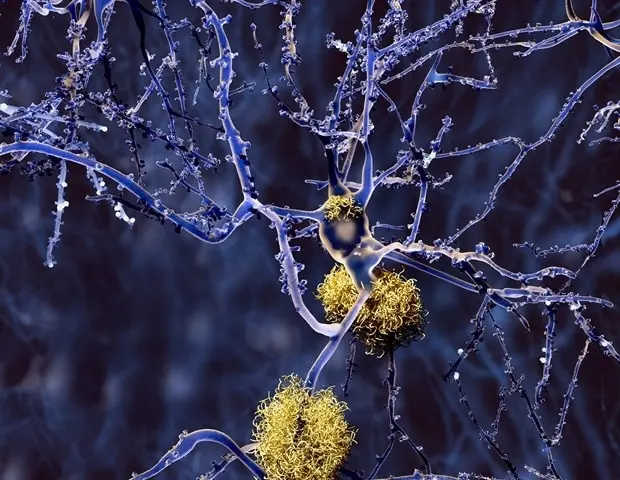 New Study Reveals Early Detection of Alzheimer's Through Brain Imaging