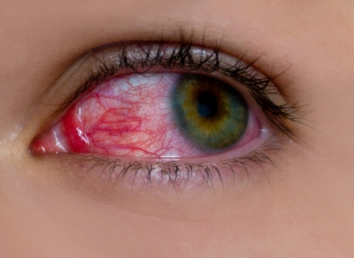 glaucoma.jpg