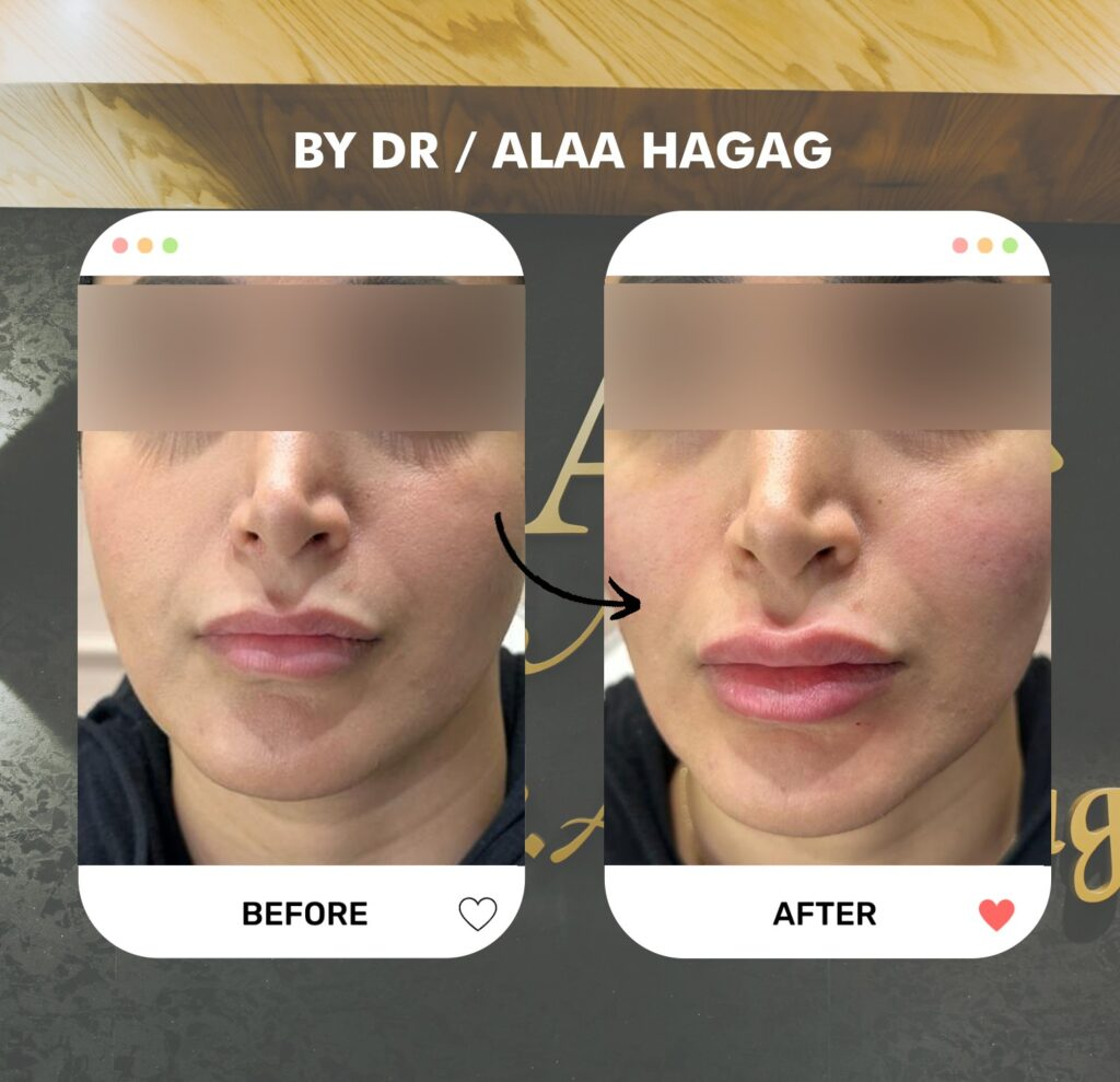 نتيجة حقن فيلر الشفايف قبل وبعد من الأمام عند د. علاء حجاج