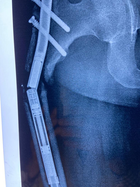 brokenleg