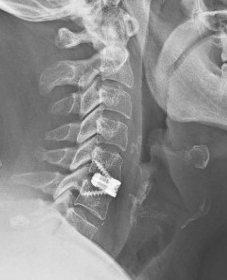 ACDF anterior cervical discectomy fusion