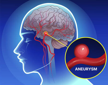 Stroke & Vascular Surgery