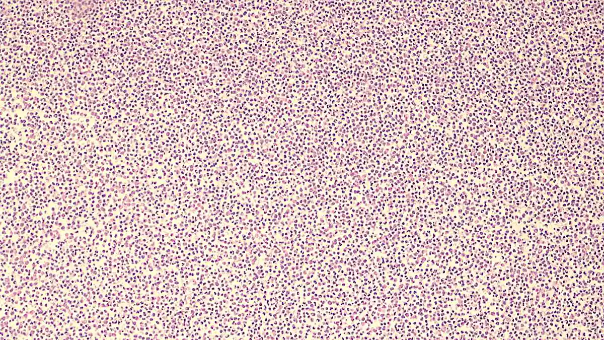 Eye Infections Pose Vision Threat