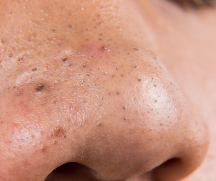 Detailed View of Blackheads and Clogged Pores
