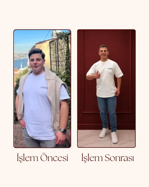 G5 Öncesi Sonrası 6
