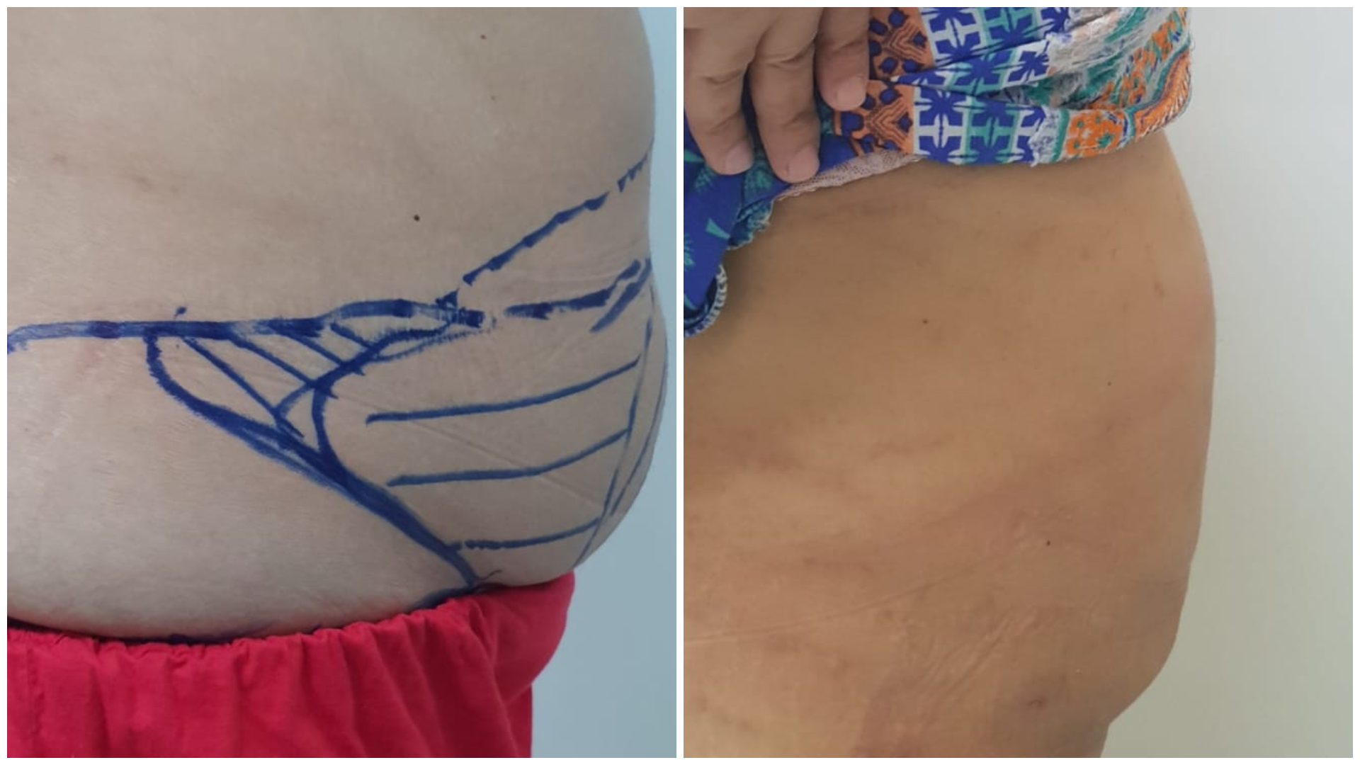 Fat Liposuction of Belly