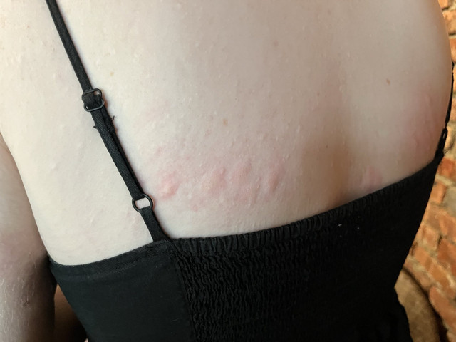 rash4
