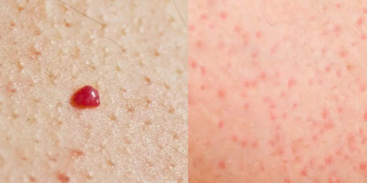Spots on Your Skin: Harmless or a Cause for Concern?