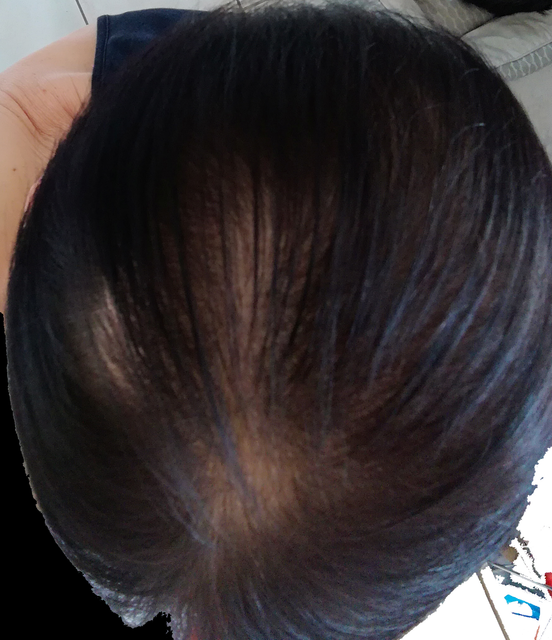 Chute de cheveux femme
