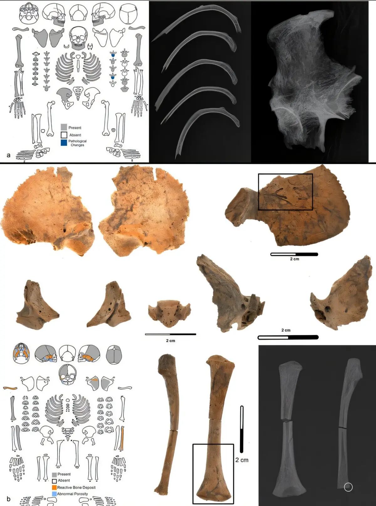 Evidence of Scurvy Discovered in Ancient California Burials