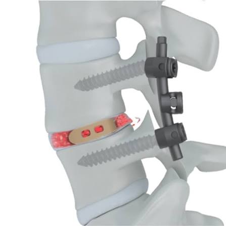 TLIF PLIF interbody fusion