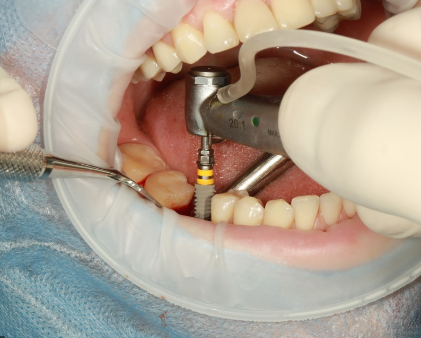 Dental-Implants-Cost