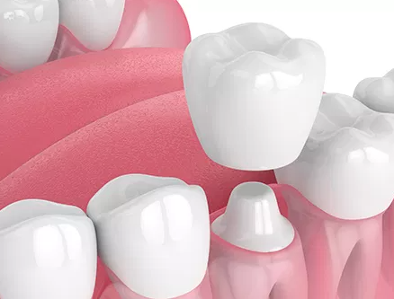 Huntington implant
