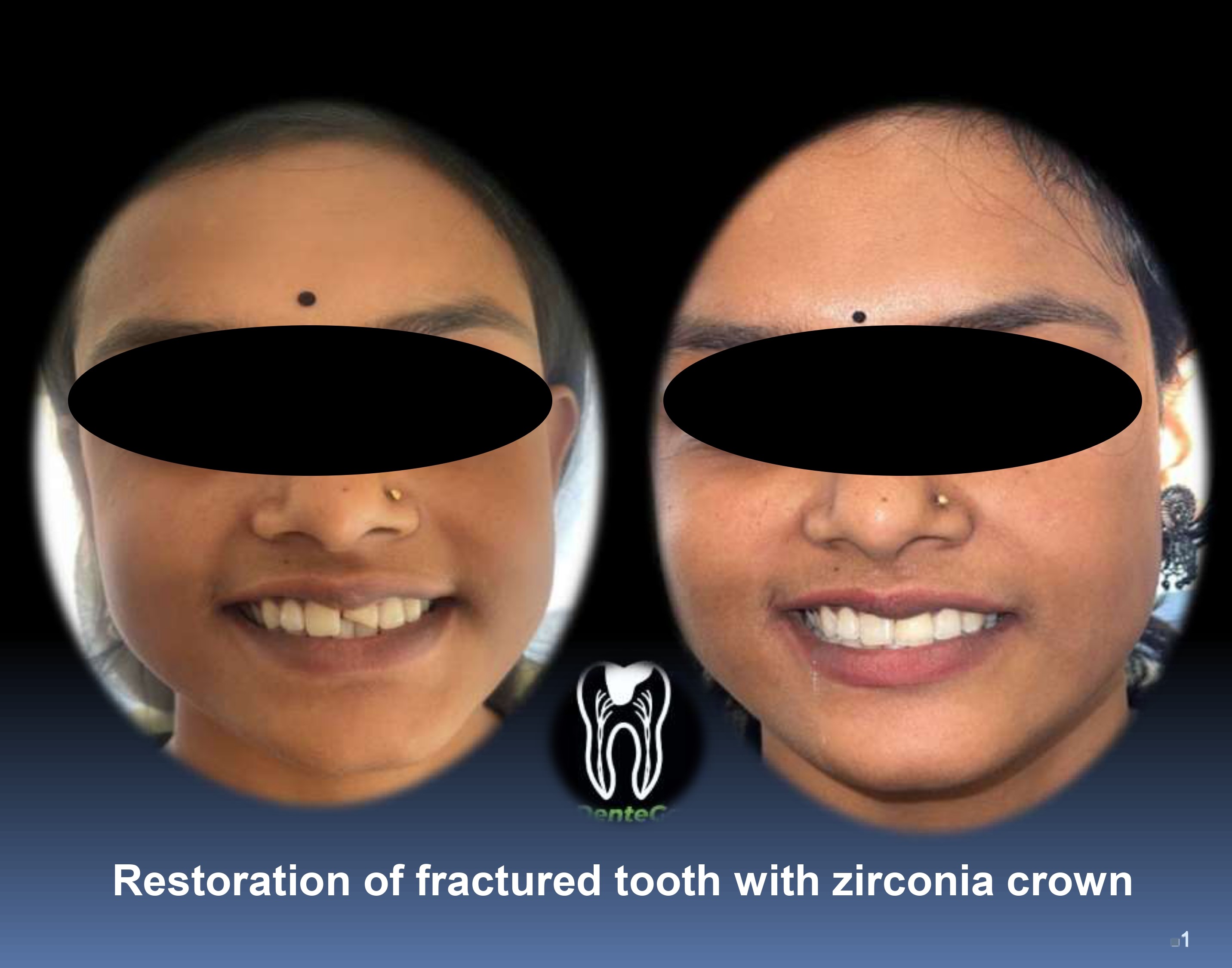 Incisal Fracture Restored with Zirconia Crown