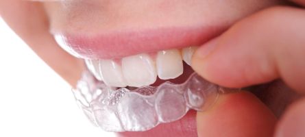 Invisalign-in-Sydney