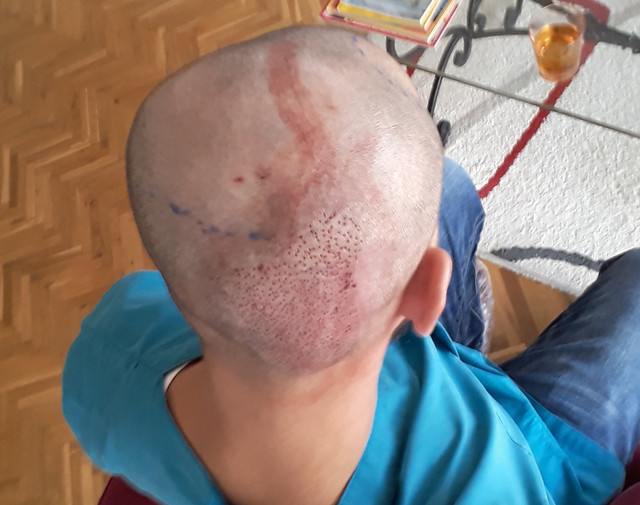 POST-OP-DONOR