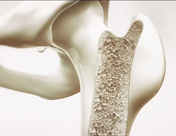 Breakthrough in Bone Repair with Mineralized DNA Hydrogel