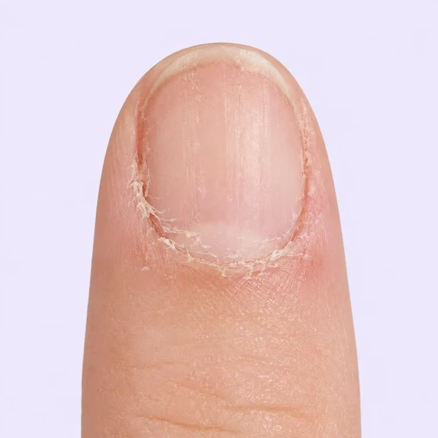 Cuticle before using the VELLUVA pen
