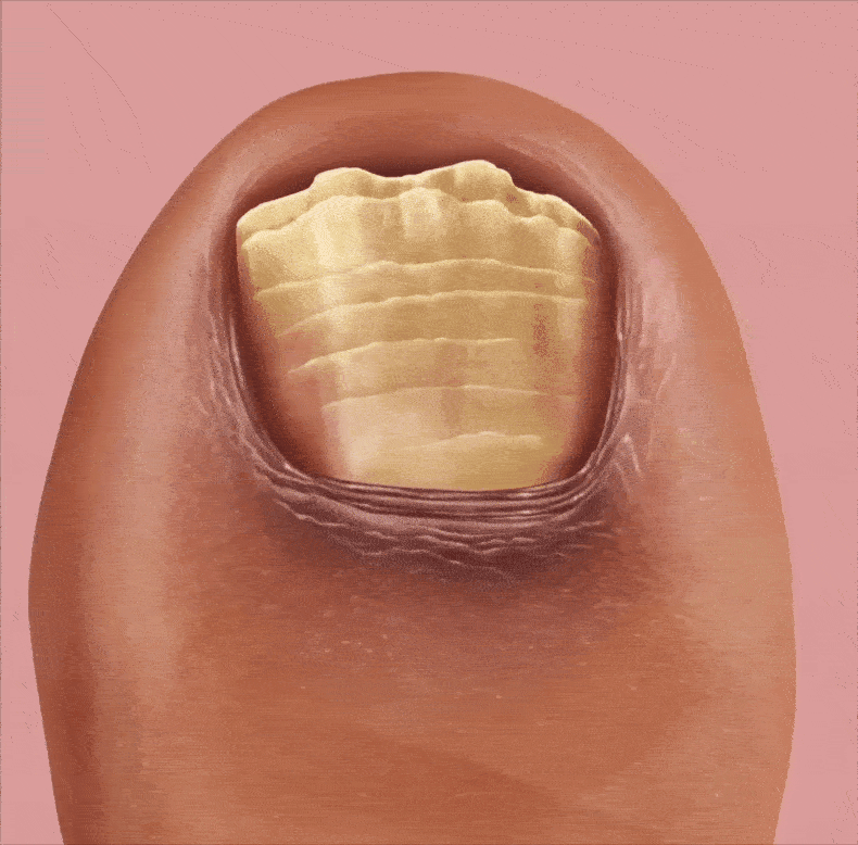 נוזל לק טיפולי לפטרת ציפורניים NailFungus