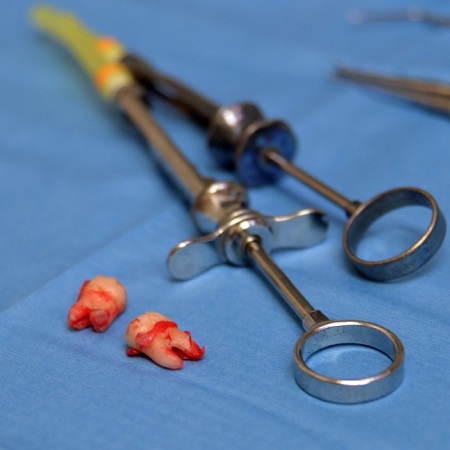Wisdom-Teeth-Removal-Sydney