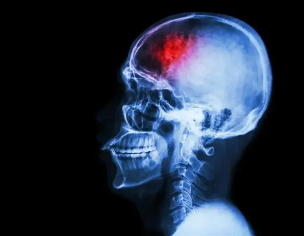 Treating Chiari Malformation: New Insights from Major Trial
