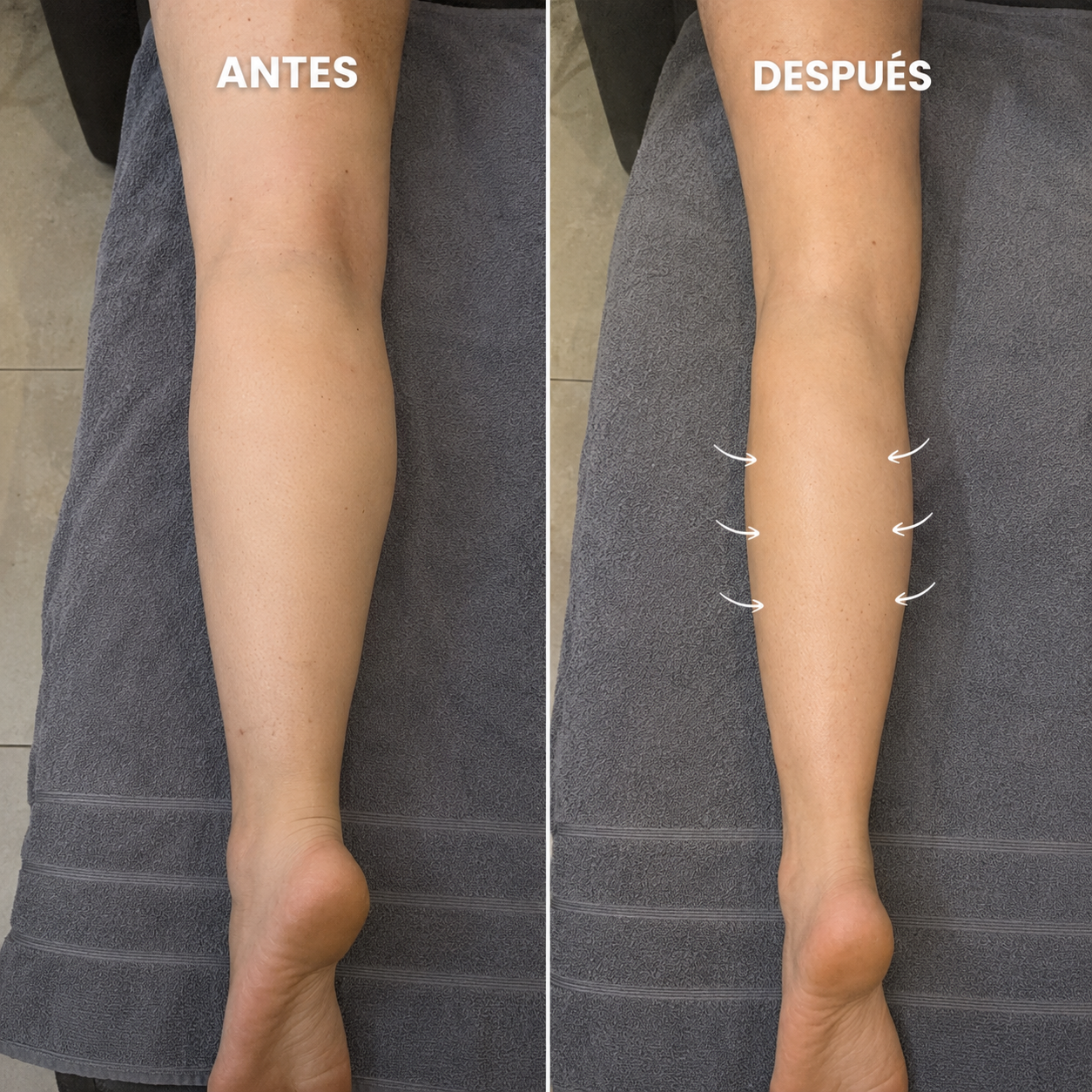 Antes y después piernas — retención por embarazo