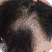 Antes