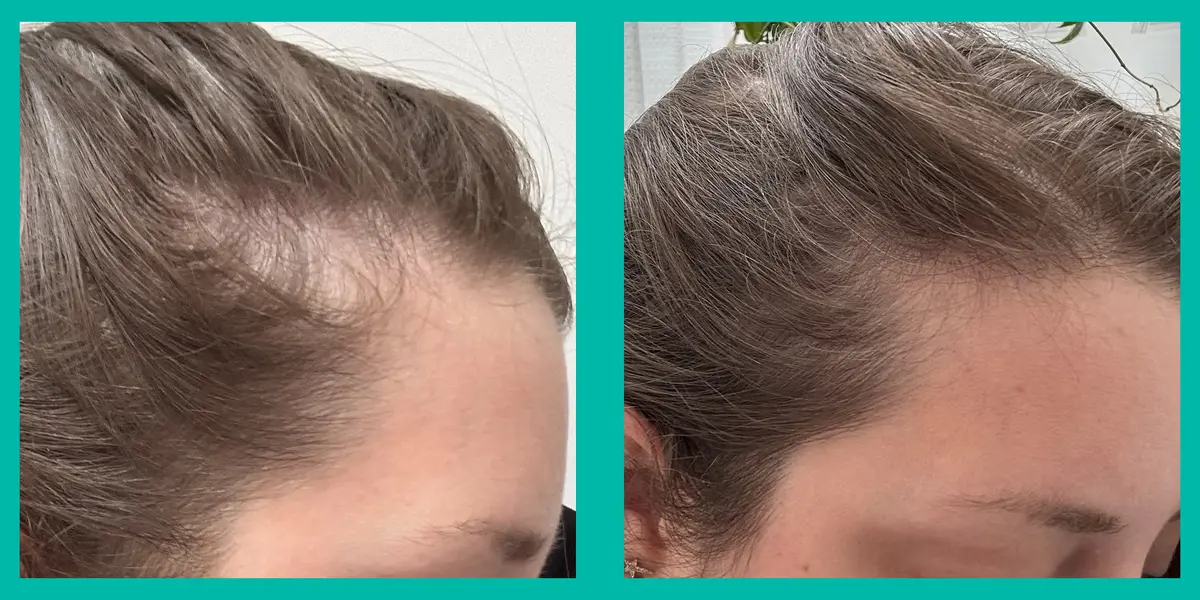 Hair Growth Capsules: Do They Really Work for Stress-Related Thinning?