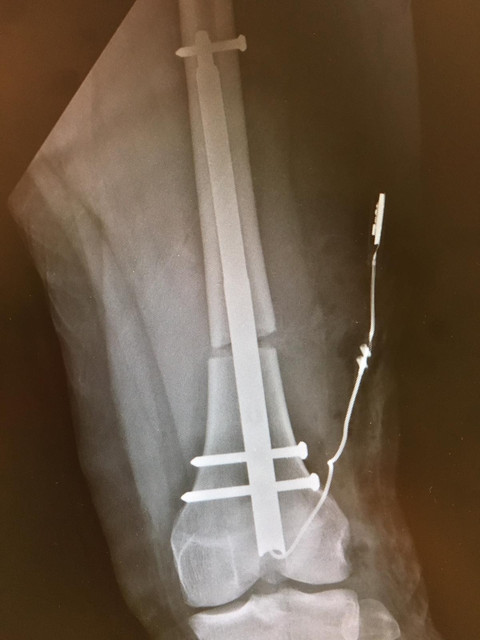 Left leg  first xrays