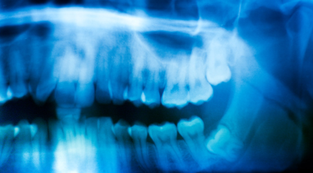 Wisdom-Teeth-Melbourne