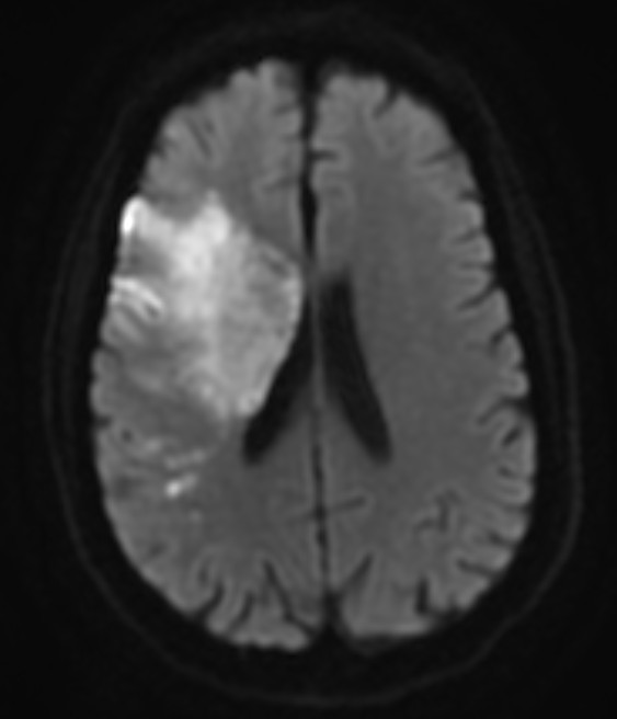 STROKE MRI 5.jpg