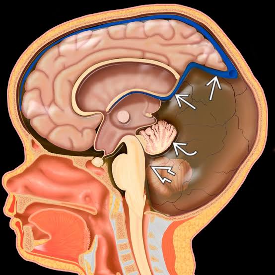Dandy-Walker malformation MRI