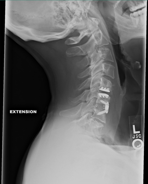 extension