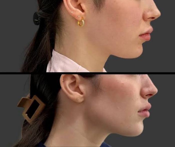 Jawline Filler Cost
