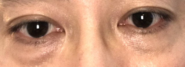 eyebag-before