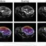 MRI Scans Show Placental Contractions Common in Healthy Pregnancies