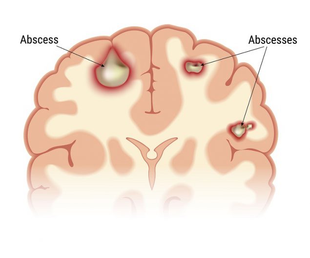 Pyogenic brain abscess