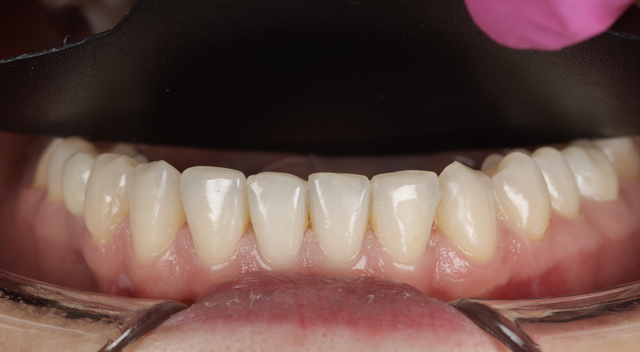 Przypadek 2 — implantologia Smile by Smile Wrocław